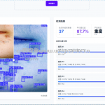 基于yolov8的痤疮识别系统