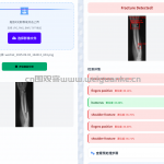 基于yolov8的骨折部位检测系统